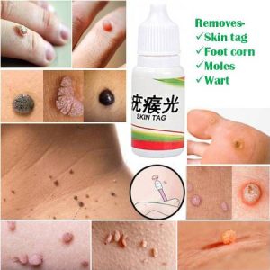 Skin Tag/mole/wart Remover